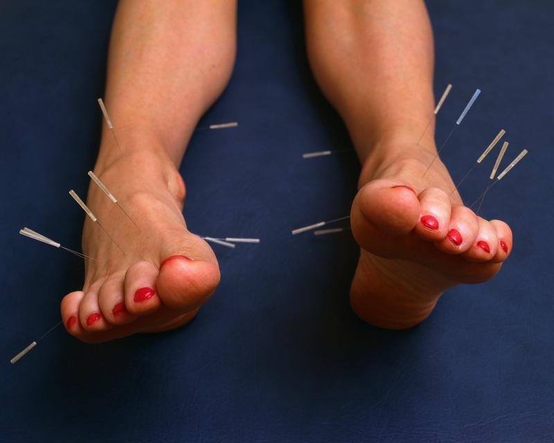 Image of needles needles inserted into two feet.